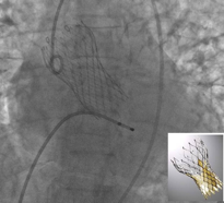 Fluoroscopia  dopo corretto posizionamento di protesi aortica Corevalve