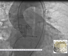 Aortografia dopo corretto posizionamento di protesi Sapien 3 aortica senza residua insufficienza valvolare